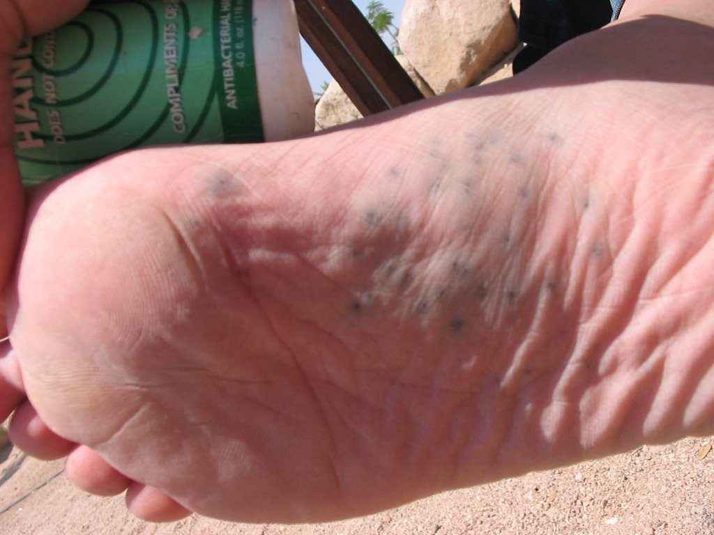 deniz kestanesi sokması